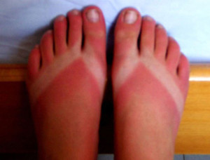 sunburned feet